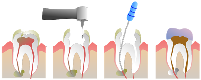 [Root_Canal_Illustration[4].png]