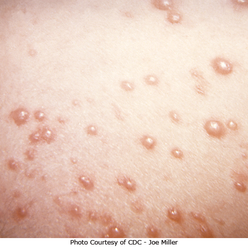 These chicken pox lesions are in the early stage - around day three or four.