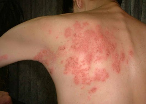 herpes zoster shingles contagious or not