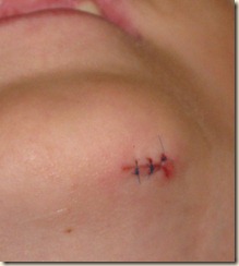 stitches-blog
