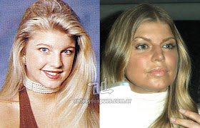 fergie antes y despues de la cirugia plastica