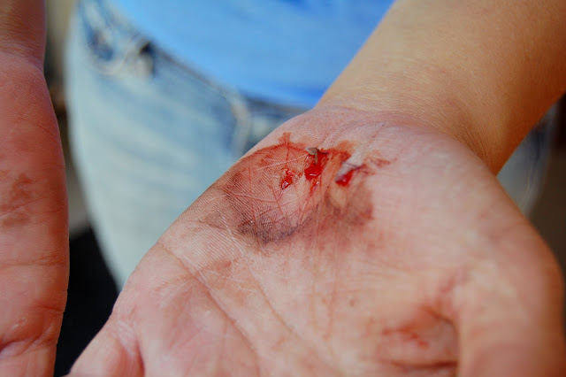Glorias scratched up hands! Yikes!