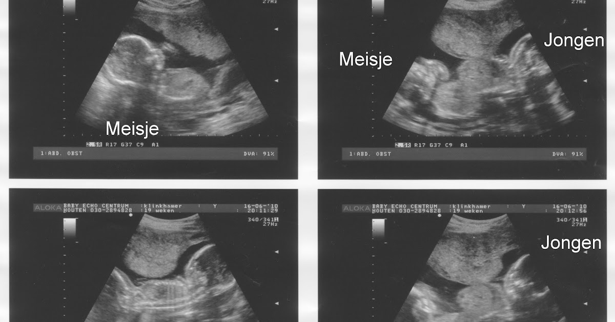 Vol leven! Een echo van onze tweeling, een jongen en een meisje! 16 juni 2010, Hoofdjes zijn