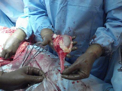 Трансплантация...