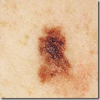 cancro_pele