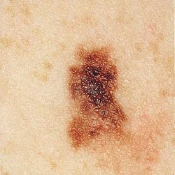 [cancro_pele[5].jpg]