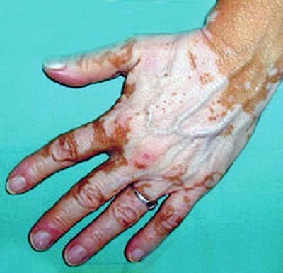 [j61-001-vitiligo[4].jpg]