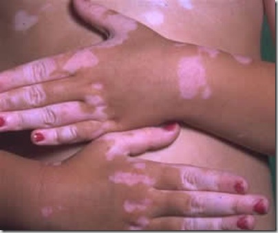 vitiligo1