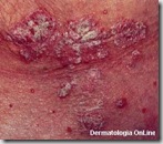psoriase-1 psoriase-1