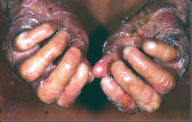 epiderm_bolhosa_05 epiderm_bolhosa_05