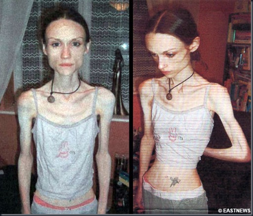 anorexia1mc3