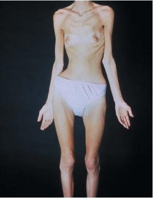[anorexia5[4].jpg]