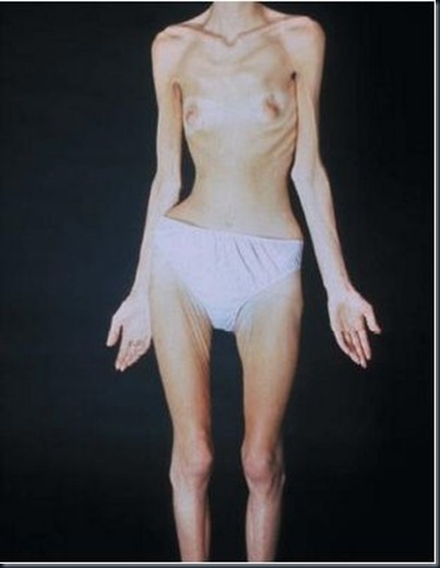 anorexia5