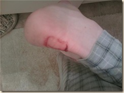 blister