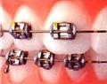 [dental braces[3].jpg]