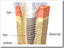 dental implant picture