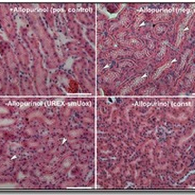 Prótesis molecular contra la gota