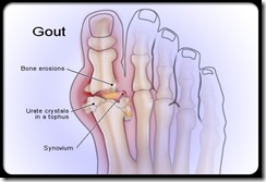 gout_illustration_s1