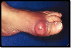 gout_big_toe_s5