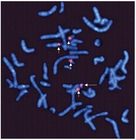 Repetitive sequence probes binding specifically to the centromeres of chromosome 14 and 22 (short arrows). The fifth signal (long arrow) shows a marker chromosome derived from either chromosome 14 or 22 