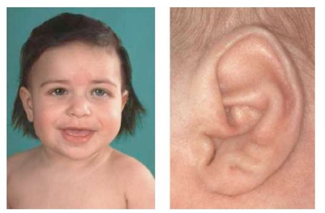 Macroglossia, nevus flameus, and ear creases in a child with BWS 