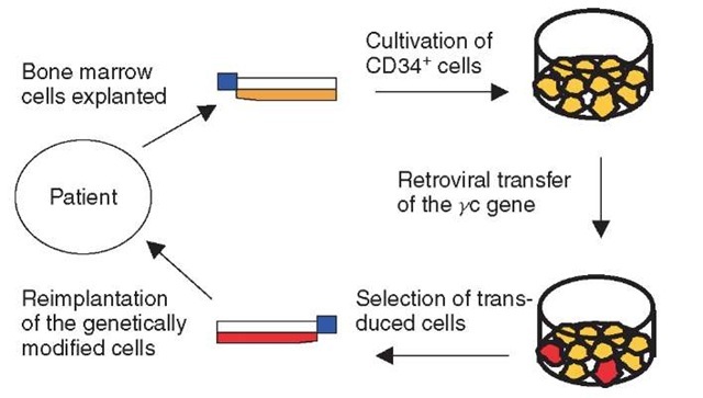 Gene therapy of SCID-X1. The first step is to purify, stimulate, and culture CD34+ cells from the patient's bone marrow. The cells are then transduced with the yc gene using a retroviral vector, before they are reinfused into the patient 