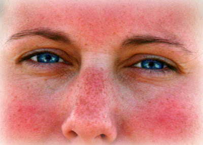 raccoon eyes