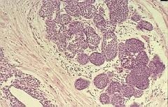 [CANCER MAMA INSITU 3[3].jpg]