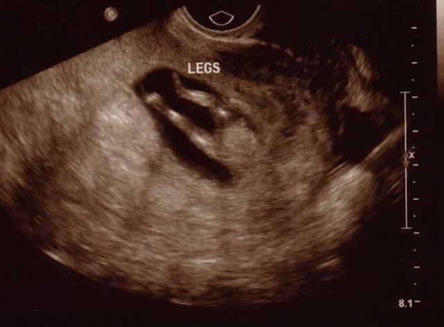 [ultrasound[4].jpg]