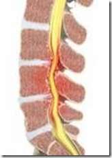 ESTENOSIS LUMBAR estenosis lumbar:
