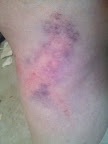 Bruise