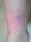 Bruise