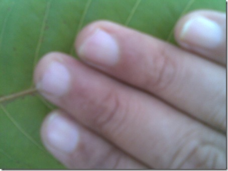 chaffed fingernails