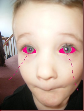 pinkeye 2