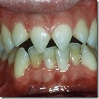 Tooth-Filling