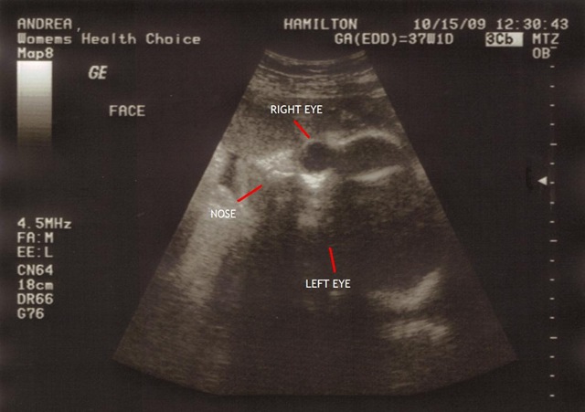 [2nd Ultrasound Face labeled[9].jpg]