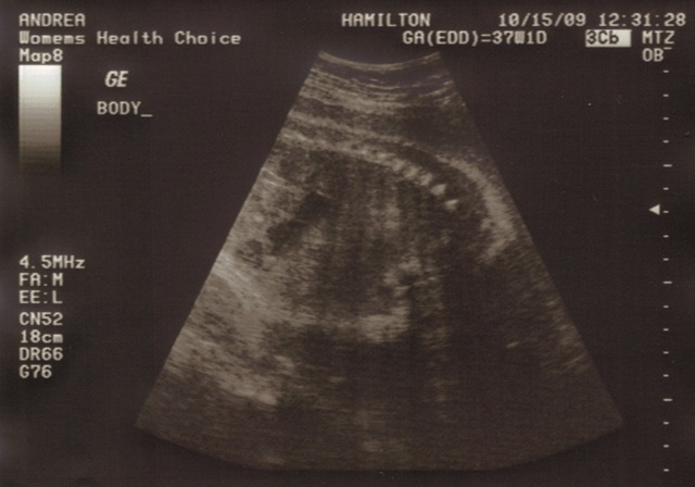 [2nd Ultrasound Body[5].jpg]