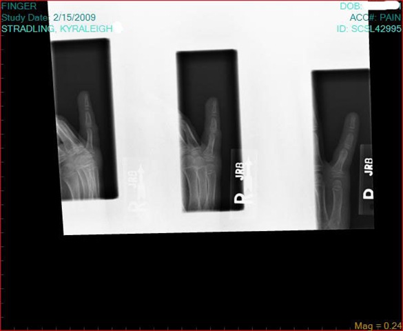 [Kyra's broken finger1[4].jpg]