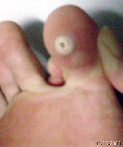 [2009-05-11 - toeCorn[12].jpg]