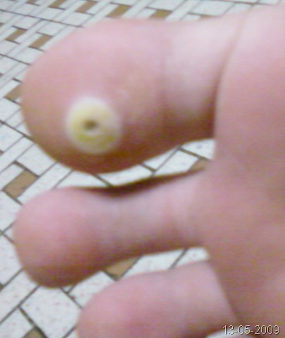 [2009-05-13 - toeCorn[3].jpg]