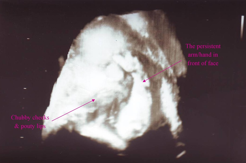 [31 Week Ultrasound_labeled[5].jpg]