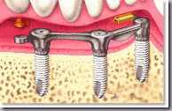dental_implant