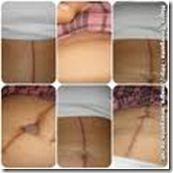Cirurgia estetica ma cicatrização Cirurgia estetica ma cicatrização