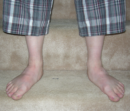 [my_feet_now[3].png]