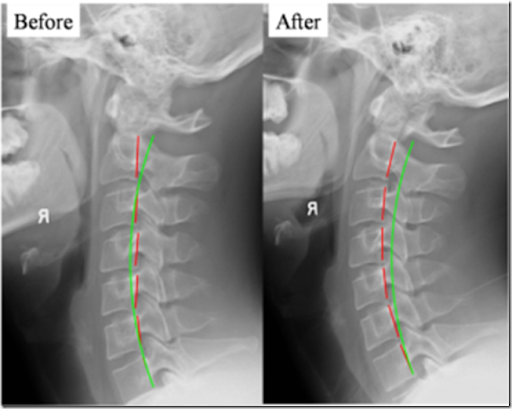 Here the green semi-circular line represents the ideal cervical lordosis 