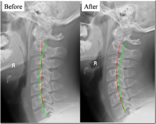 Here the green semi-circular line represents the ideal cervical lordosis Here the green semi-circular line represents the ideal cervical lordosis