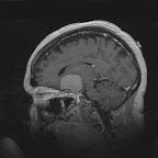 Meningioma (เนื้องอกของเยื่อหุ้มสมองหรือไขสันหลัง)
