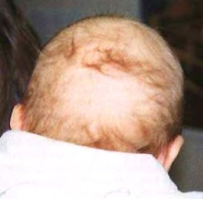 Neonatal hair loss
