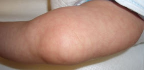 cutis marmorata