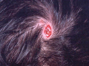 aplasia cutis congenita